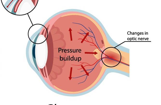 Glaucoma Treatment